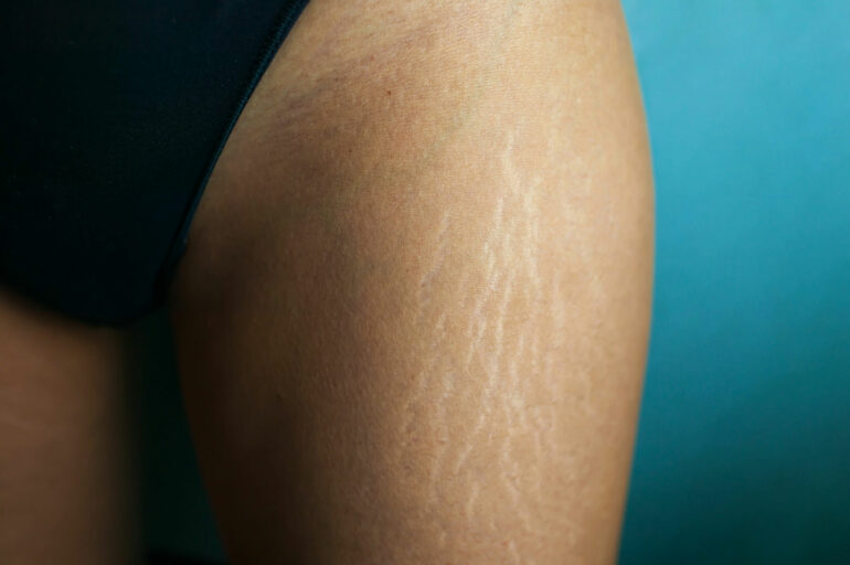 The image shows the thigh of a woman in black underwear. Stretch marks are visible, with the focus on the upper part of the thigh.